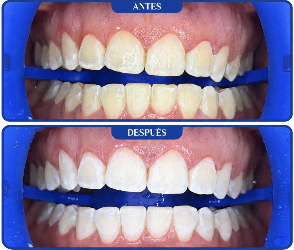 Antes y después de la primera sesión de aclaramiento dental