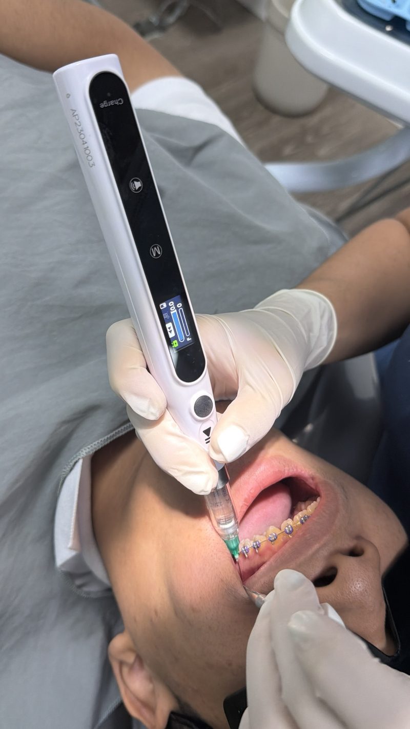 Odontólogo aplicando anestesia con un equipo digital en forma de lápiz a un paciente con brackets