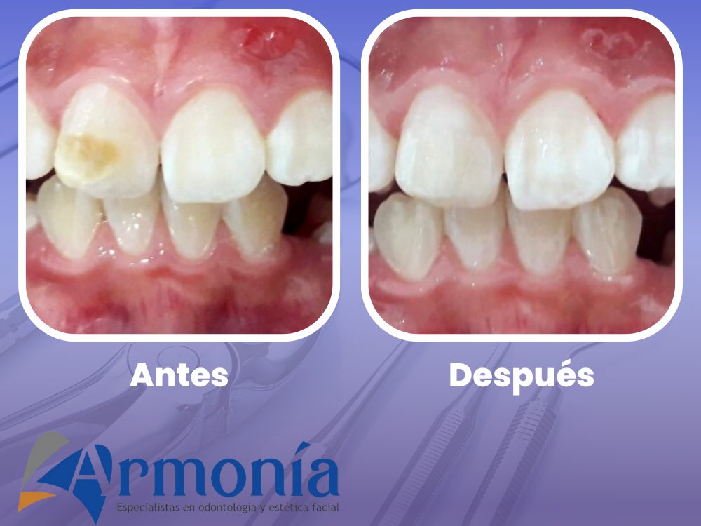 Antes y después de un tratamiento estético en un diente frontal